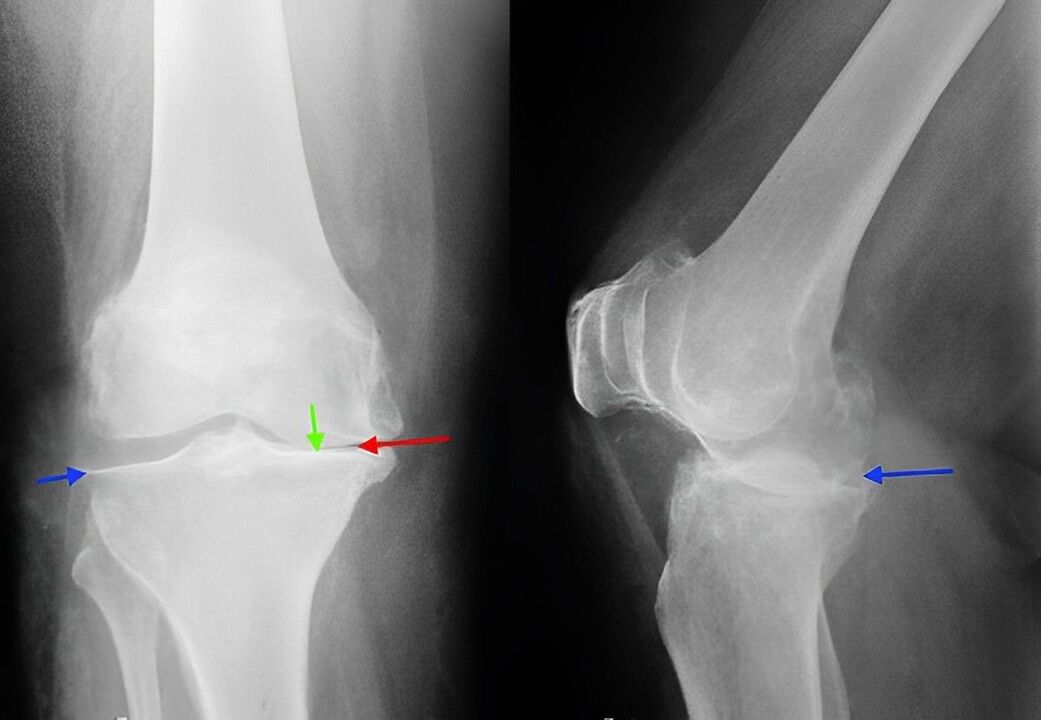 ακτινογραφία αρθρώσεως της άρθρωσης του γόνατος