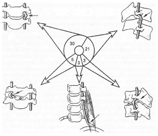 ποιος είναι ο κίνδυνος της οστεοχόνδρωσης του λαιμού;