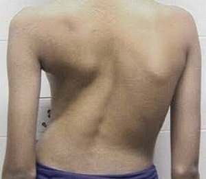 σκολίωση ως αιτία του πόνου στην πλάτη